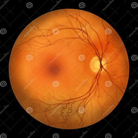Retinal Arteriovenous Malformation Illustration Stock Illustration