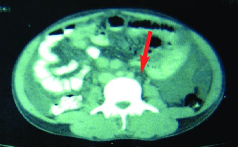 Contrast Enhanced Computed Tomography Scan Showing Enlarged Para Aortic