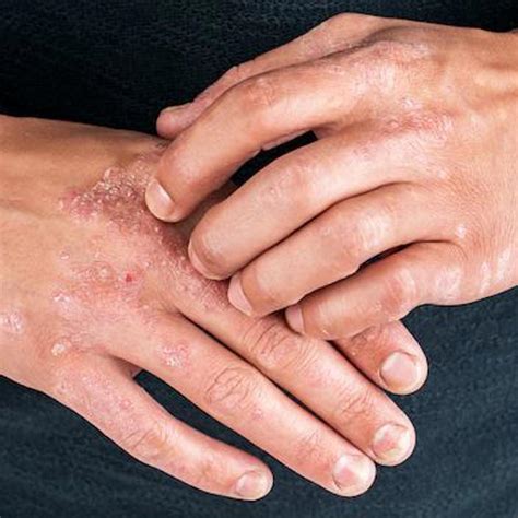 Is Eczema A Genetic Disease The Tech Interactive