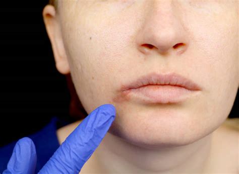 Centers for disease control and. Best Herpes Labial Stock Photos, Pictures & Royalty-Free Images - iStock
