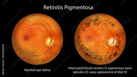 Retinitis Pigmentosa A Genetic Eye Disease Leading To Vision Loss An