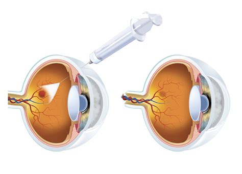 Monthly eye injections of avastin (bevacizumab) are as effective as the more expensive drug eylea (aflibercept) for the treatment of central retinal vein occlusion (crvo), according to a clinical trial. Avastin Lucentis Eylea Injections | Retina Steroid Injections