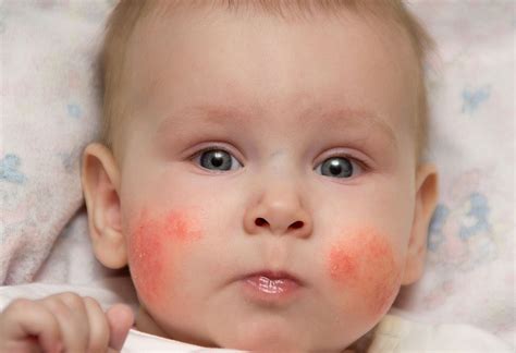 Baby Rash On Face Types Reasons And Home Remedies