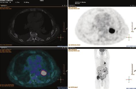 Total Body Pet Ct Imaging Showing Diffuse Disease With Maximal Activity