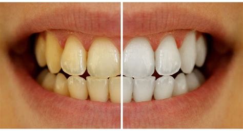 How to reduce gap between teeth naturally at home without braces. Yellow Teeth? Do Your Teeth Need Cleaning? | General ...