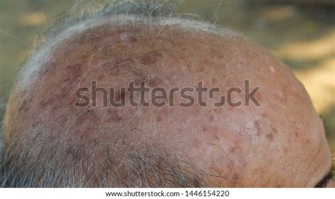 Age Spots Front Bald Head Old Stock Photo 1446154220 Shutterstock