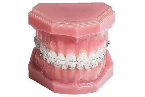 Ceramic Braces Orthodontics At Bristol Dental Specialists