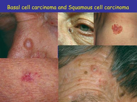 Skin Cancer Melanoma Basal Cell And Squamous Cell Carcinoma Sexiezpix Web Porn