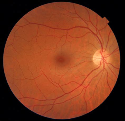 How The Retina Is Connected To Overall Body Health - Victoria, BC