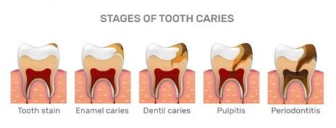 How To Prevent Cavities Tooth Decay And Get Rid Of Dental Caries
