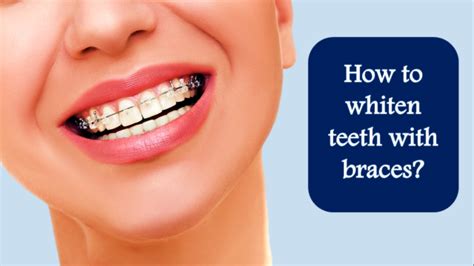 How To Whiten Teeth With Braces 4 Best Teeth Whitening Ways