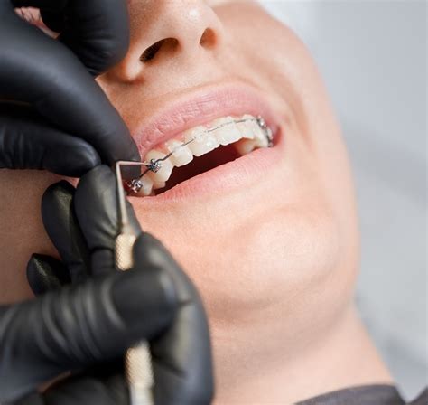 Todo Lo Que Debes Saber Sobre La Ortodoncia Con Brackets Implantes
