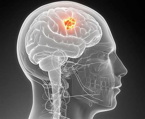 Aggressive Brain Tumors Temporarily Halted Using Genetically Modified