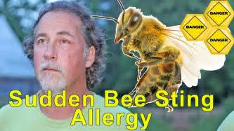 Warning Sudden Bee Sting Allergy Signs Symptoms And Dangers Of