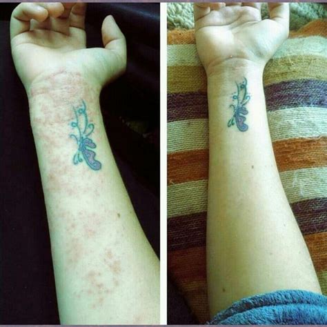 Do Tattoos Help Eczema Be A Large Biog Image Archive