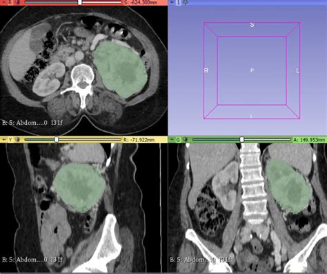 Segmentation Of The Tumor In The Left Kidney In Three Planes And