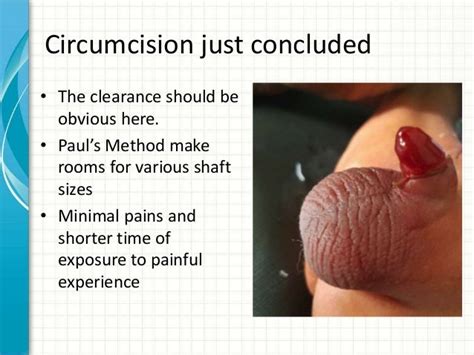 The Benefits Of A Circumcision Ring