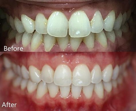 What Is Invisalign Teeth Straightening Orthodontics Northcote Vic