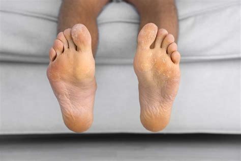Safety Tips For Foot Neuropathy Vertigo Detective