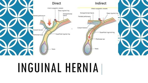 Hiatal Hernia Types