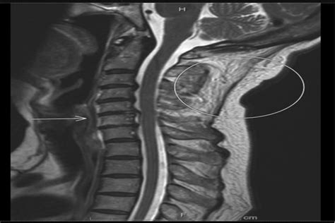 Unstable Cervical Spine Secondary To Ligamentous Injury From
