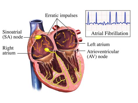 atrial fibrillation pathophysiology