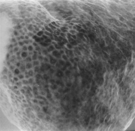 Lymphoid Hyperplasia Of The Stomach Radiographic Findings In Five Adult