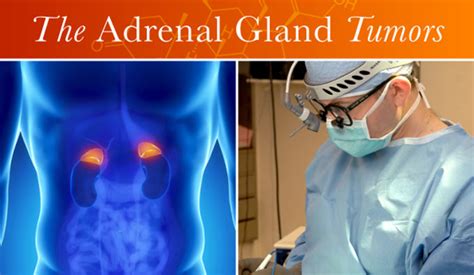 Adrenal Incidentaloma Adrenal Guidelines