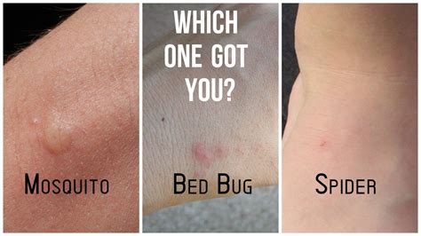 Mosquito Bed Bug Spider Bite Differences Bed Bug Bites Bed Bugs