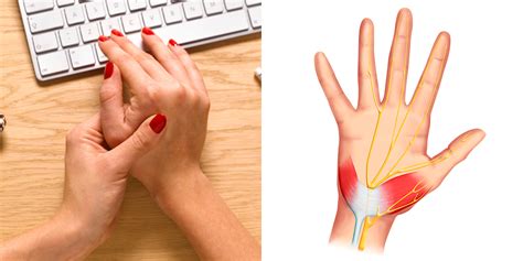 2 Carpal Tunnel Syndrome Symptoms You Shouldnt Ignore Self