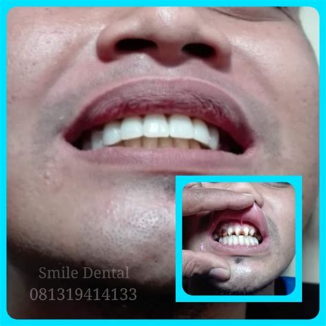 We did not find results for: AHLI GIGI PALSU " SMILE DENTAL" | Melayani Pembuatan ...
