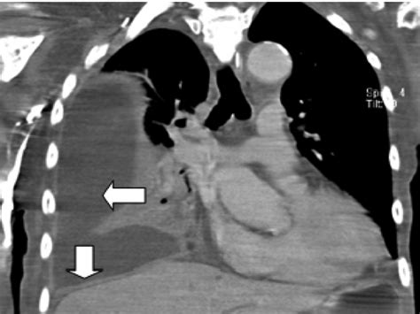Pleural effusion develops when more fluid enters the pleural space than is removed. Loculated right pleural effusion with pleural enhancement ...
