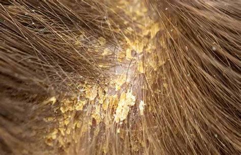 Wet Dandruff What Is It And How To Treat It 5 Home Remedies
