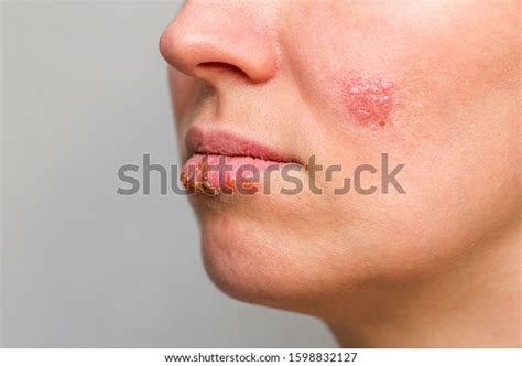Closeup Common Cold Sore Virus Herpes Stock Photo 1598832127 Shutterstock