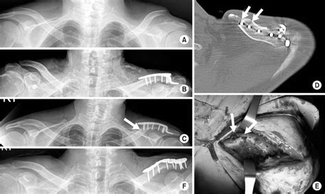 Periprosthetic Fracture After Hook Plate Fixation In Neer Type Ii