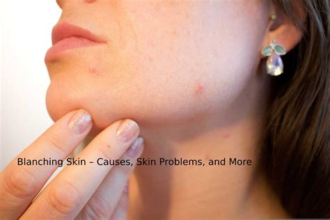 Blanching Skin Causes Skin Problems And More