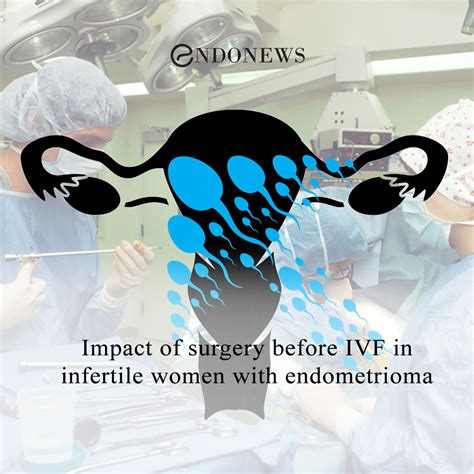 Impact Of Surgery Before IVF In Infertile Women With Endometrioma EndoNews