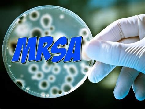 Die lokalisation, der wundrand und die wundumgebung. Mrsa in der wunde ansteckend, decon-x fjerner mrsa ...