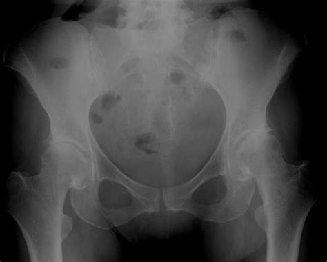 Total Hip Replacement In A Middle Aged Female Patient With Bilateral