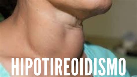 Entenda O Hipotireoidismo Sintomas Causas E Tratamento