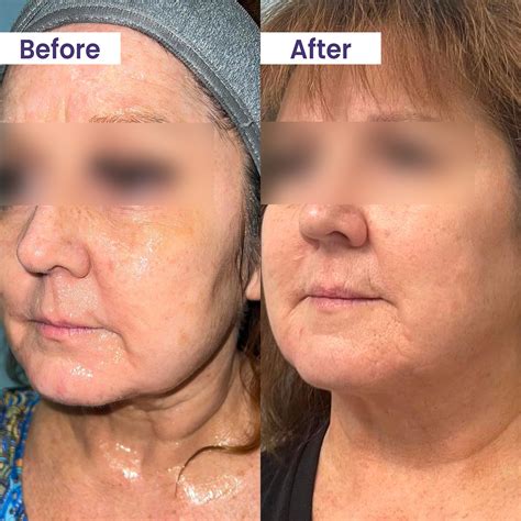 Transform Your Skin with the Morpheus8 Microneedling Treatment | Blurr