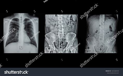 Film Acute Abdomen Series Patient Abdominal Stock Photo 1261648159