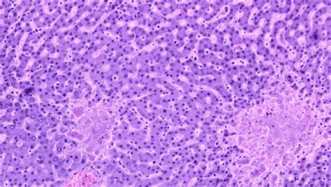 Histological Findings At Autopsy Hepatic Parenchyma With Foci Of