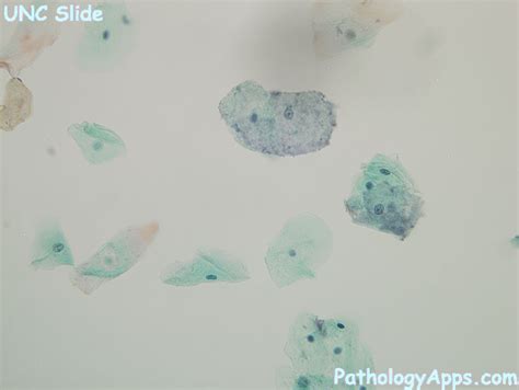 Bacterial Vaginosis Cervix Cytology