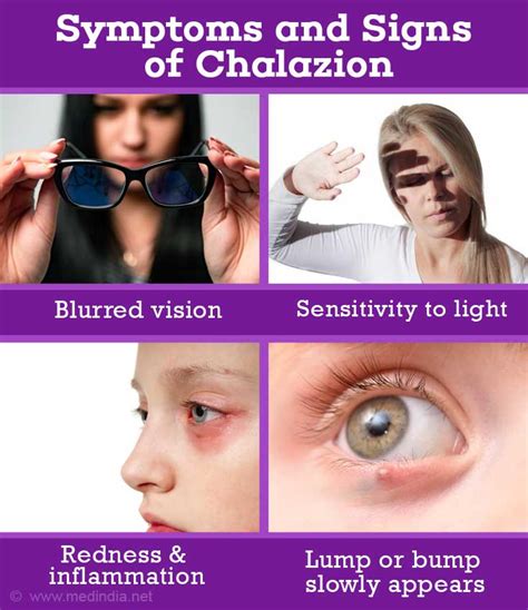Chalazion Eyelid Condition Causes Symptoms Signs Diagnosis