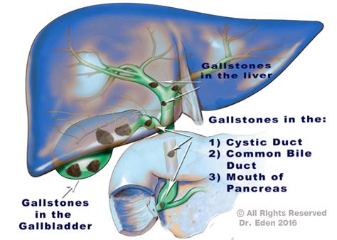 Gallstones Cause Gallbladder Stones Signs Of Gallbladder Symptoms
