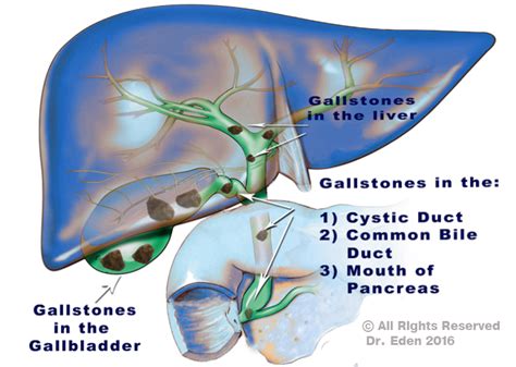 All this can be done for you by the company booking health. Gallstones Cause | Gallbladder Stones | Signs of ...