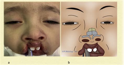 The Nasal Cantilever Technique In Children Undergoing Primary Cleft Lip