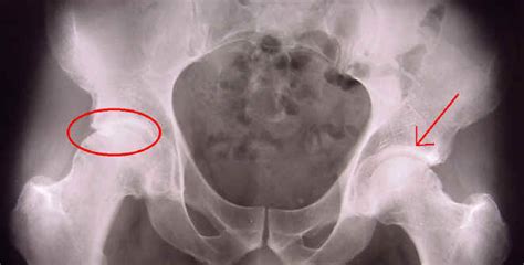 Hip Surface Replacement