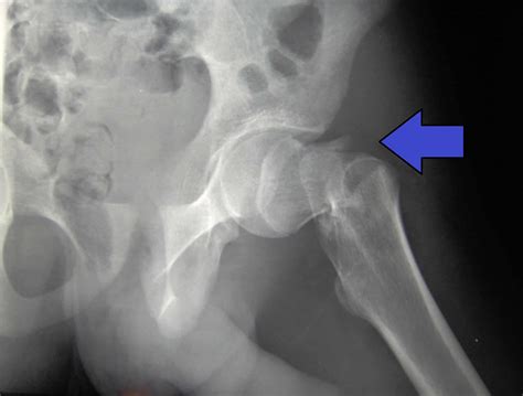 Hip Fracture Neck Of Femur Nof Almostadoctor
